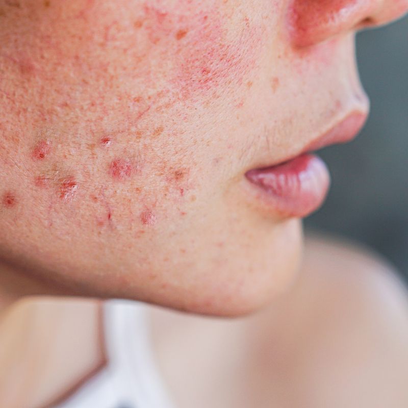 acne on the cheek