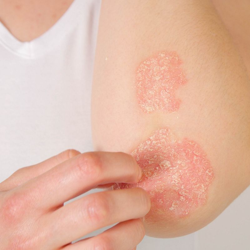 woman with psoriasis on elbow