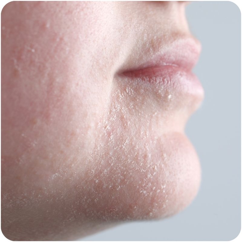 Side shot of someone's face with skin allergies.
