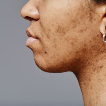 Image of a person with skin pigmentation issues.