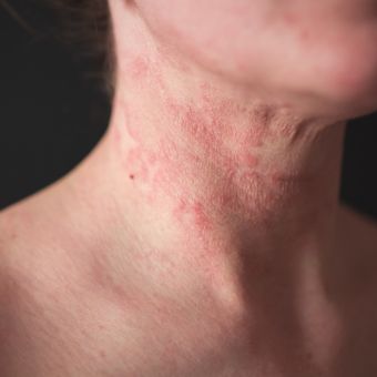 Image of a person with eczema on their neck.