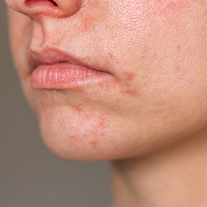 woman suffering from perioral dermatitis near the mouth.
