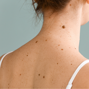 Woman with a melanoma on her neck