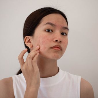 woman struggling with acne