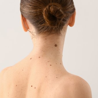 Woman with hair styled in a bun showing her back that displays multiple moles