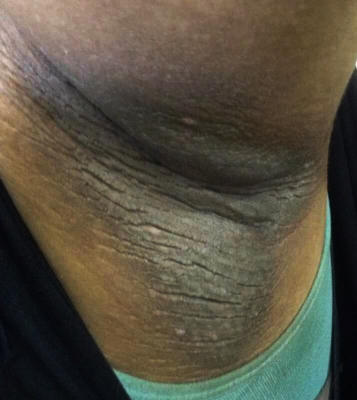 Acanthosis nigricans presents itself on the armpit of a client.