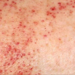 A patch of skin affected by petechiae.