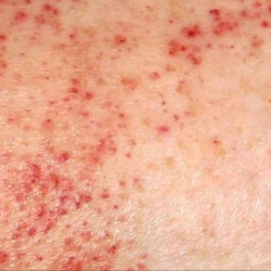 platelet disorders pinpoint rash