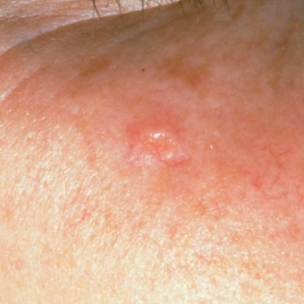 sebaceous glands bumps