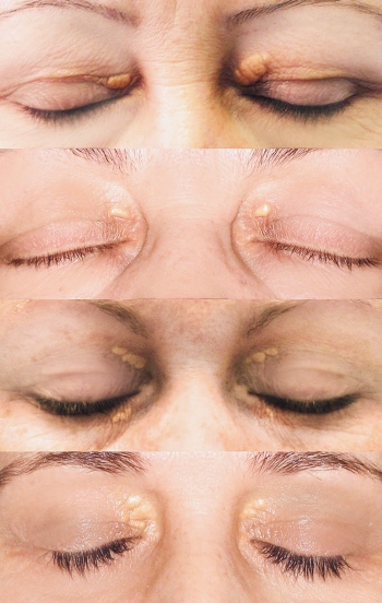 Four clients with eyelids affected by xanthelasma/xanthoma lesions.
