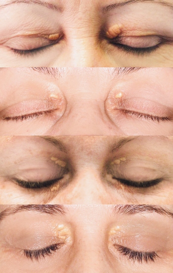 Skin Challenge: Xanthelasma  Associated Skin Care Professionals