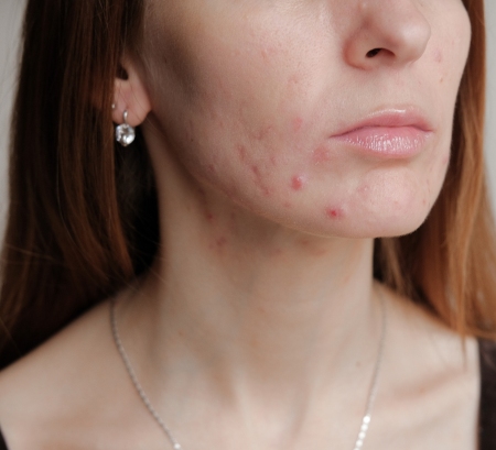 PCOS jawline acne shown on a female client.