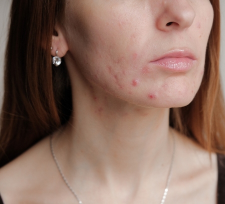 pcos symptoms acne