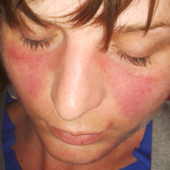 A butterfly skincare rash is displayed across a client's cheeks and nose.