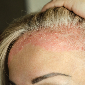 A female client's hairline is affected by asteatotic eczema.
