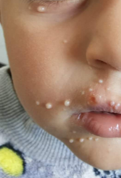 A client with white facial molluscum contagiosum presented as small round papules.