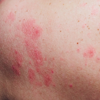 A patch of skin affected by a urticaria hepatitis weal on skin.