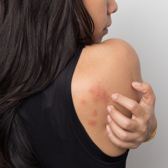 Urticaria hepatitis affects the back right shoulder of a client.