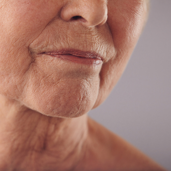 A client deals with glycation of the skin, resulting in wrinkles around the nose and mouth.