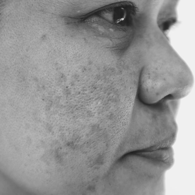 Woman with Melasma