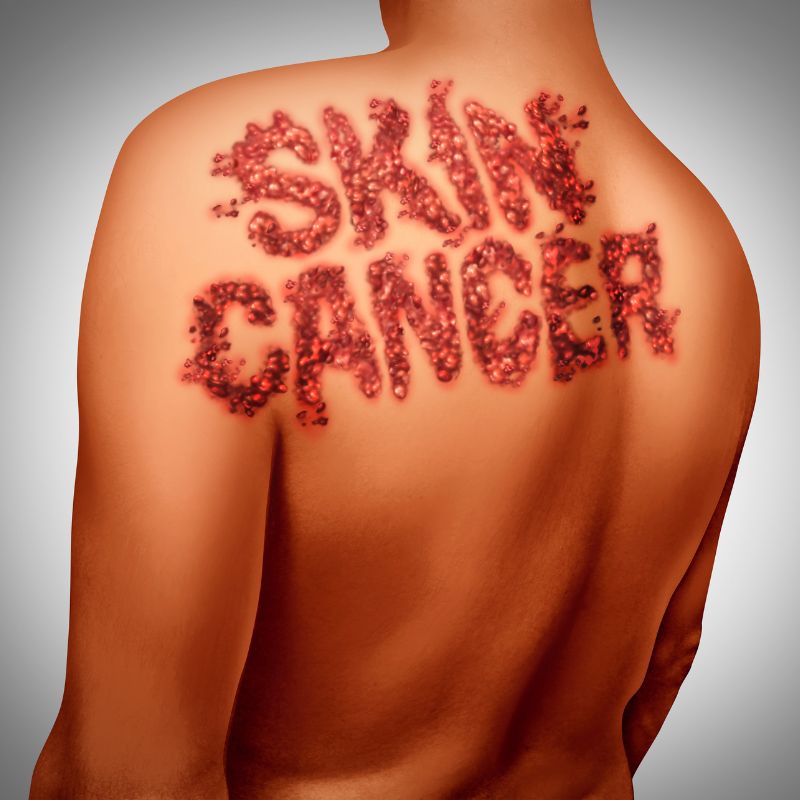 Skin Cancer on back