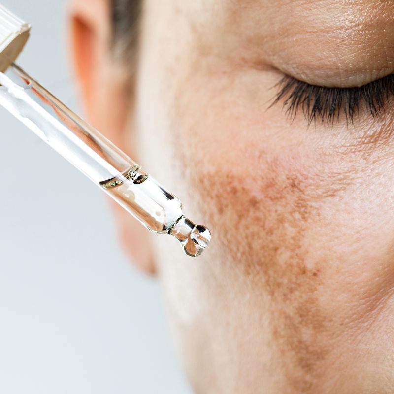 Image of a client receiving treatment for melasma.
