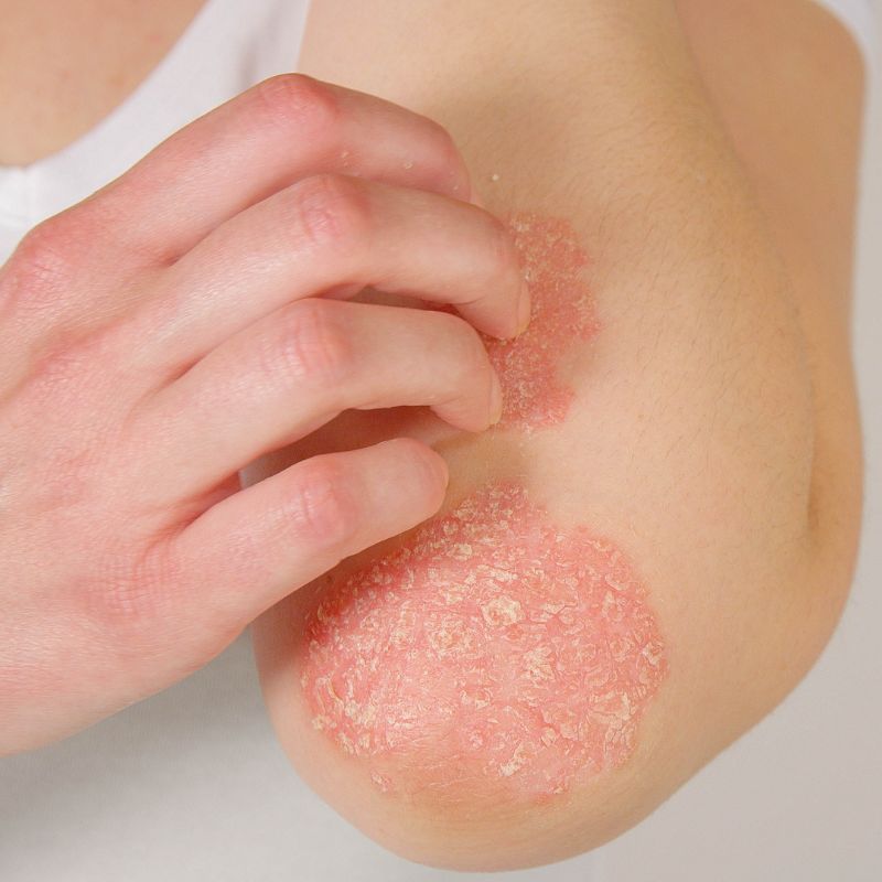 Image of a person with psoriasis around the elbow.