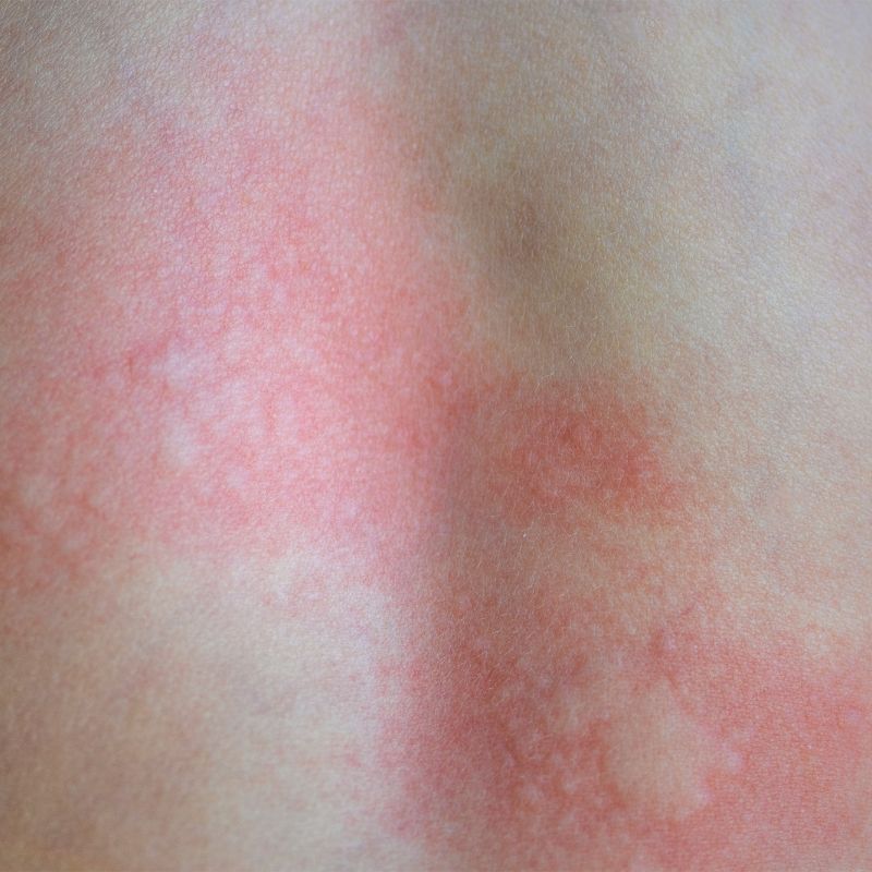 Image of hives and rash on a persons back.