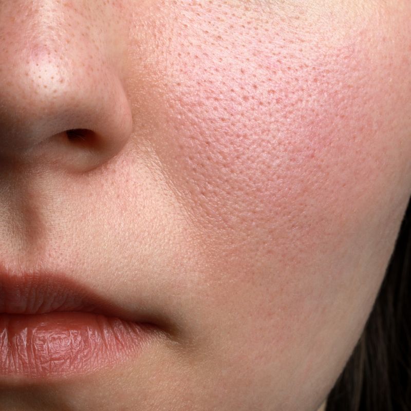 Image of a persons face showing sensitive skin.