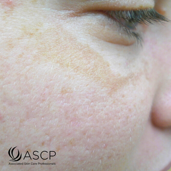 Person with Melasma