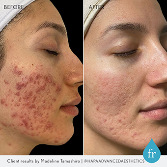 A client displays her side profile before and after a professional acne peel treatment.