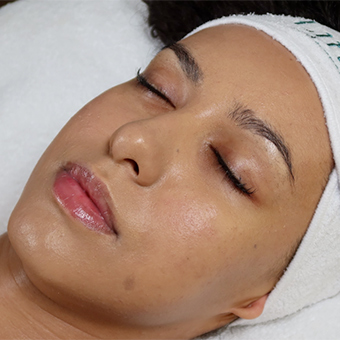 Facial skin after peptide treatment