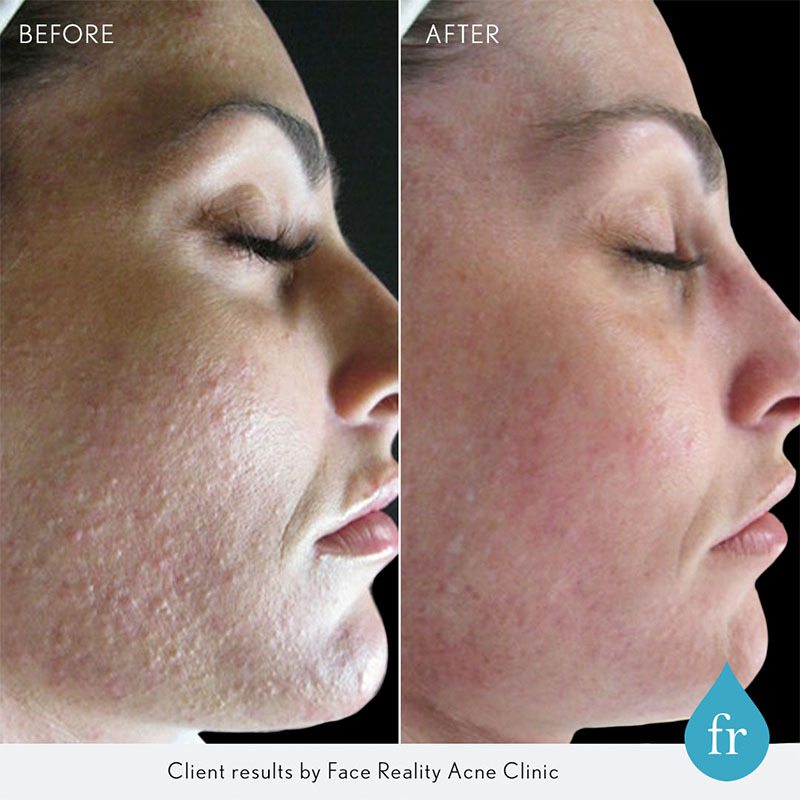 Split image of acne improving