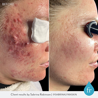 An acne-prone client shows before and after views from her professional acne peel treatment.