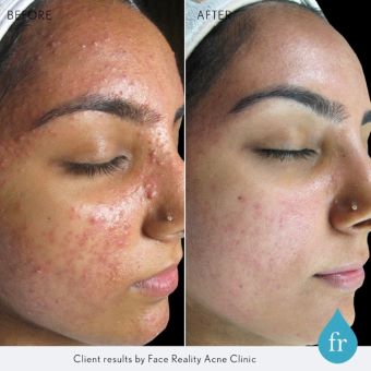 Acne before and after peel