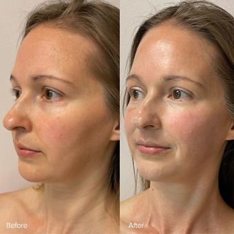 A female client displays before and after results from her microcrystal dermal infusion treatment. 