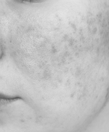 Cheek with rosacea