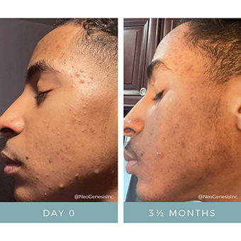 A male client who struggles with acne shows before and after pictures from his stem cell acne treatment. 