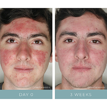 A male client with cystic acne sees incredible before and after results from his stem cell acne treatment. 