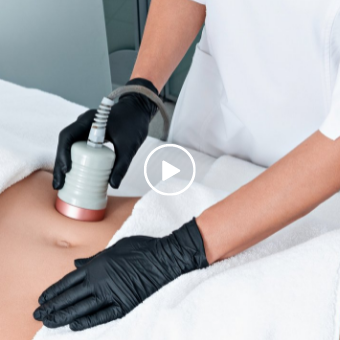 Client receives body contouring, fat cavitation