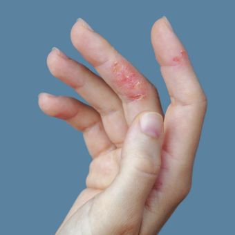 Contact dermatitis on the fingers