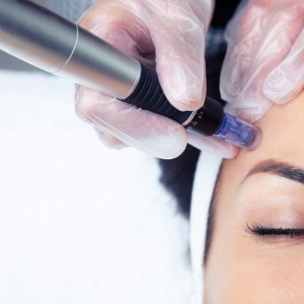 Client receiving a Microneedling treatment