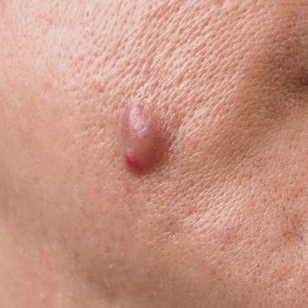 Cyst
